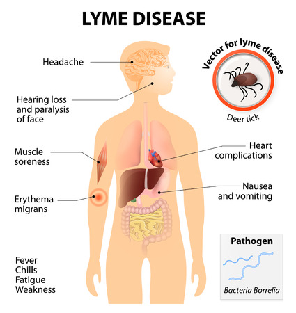 lyme disease | Any Pest Inc.